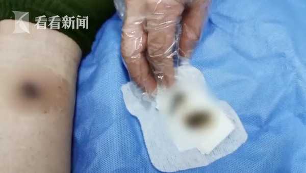 针戳皮肤压着穴位减肥？女子全身埋20多根线 腿部出现“血窟窿”