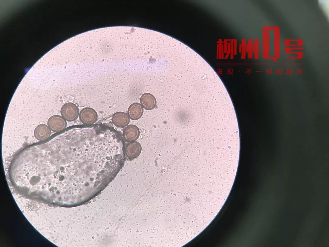 小圆圈为绦虫卵生活中人感染绦虫病十分少见,像张女士这样的情况一般