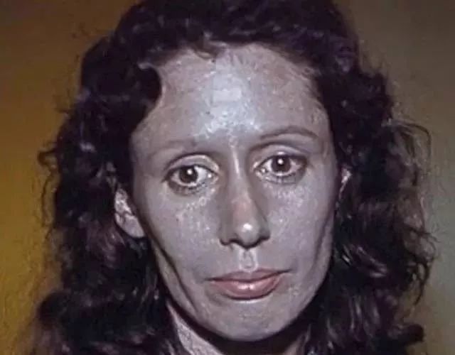 血红素的酵素(根据酶的缺陷可将卟啉症分为8型,也有后天患病的患者,如