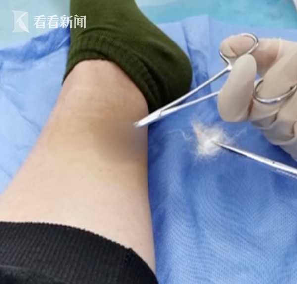 女子压穴位减肥全身埋20多根线 腿部出现血窟窿（组图） - 1