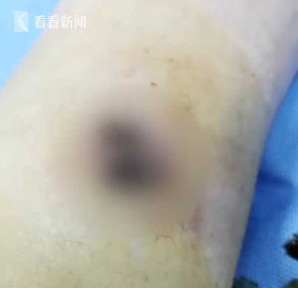 女子压穴位减肥全身埋20多根线 腿部出现血窟窿（组图） - 3