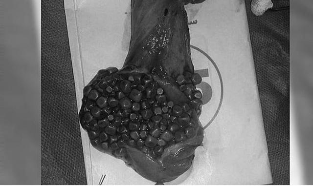 吃饱就上腹闷胀 小心瘦子也会胆结石