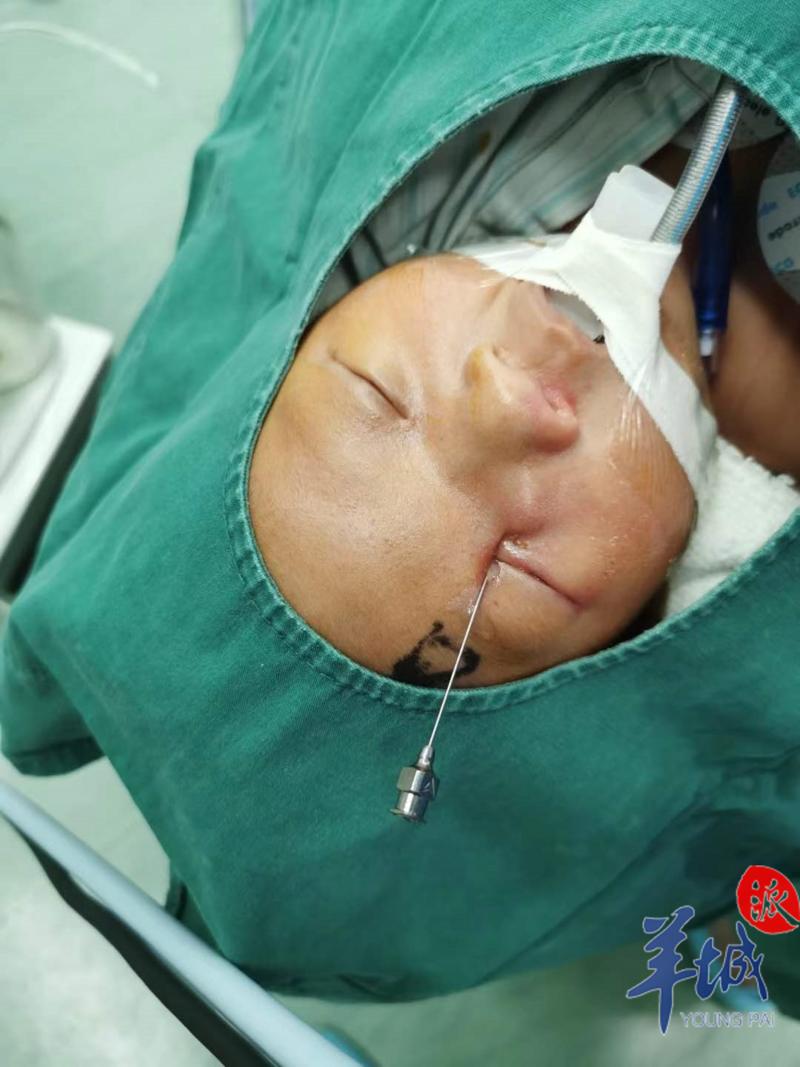 出生18天的泪囊炎宝宝谁能帮你疏通泪道