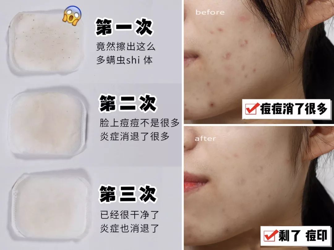 【春节不打烊】拒绝"螨虫脸"!