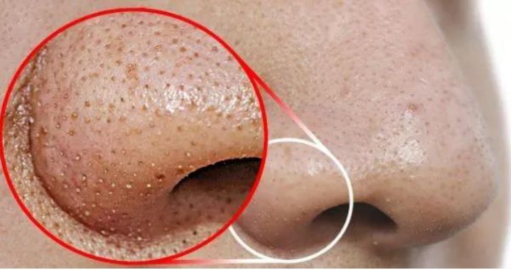 5秒揉一揉,螨虫全出来了,痘痘黑头全没了!