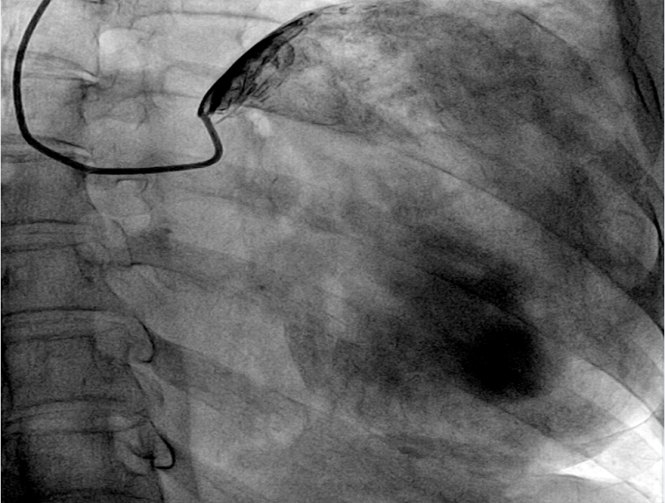 冠脉造影报告单图片