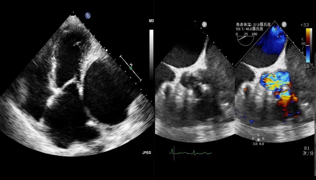 心脏彩超提示巨大冠状动脉瘤合并多瓣膜疾病