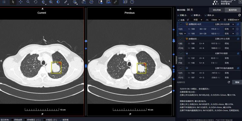 AI医疗企业扎堆进入肺结节赛道 千亿市场有望迎资本暖春