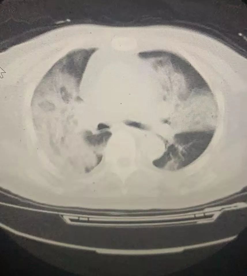 一名疑似患者的肺部CT图，肺部基本全“白”了