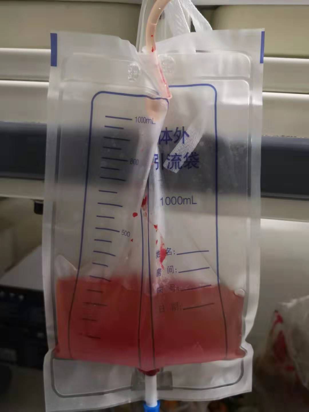 腰椎术后头晕,头痛可能是脑脊液外漏,你考虑到了吗?