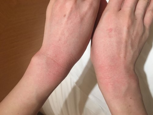 一双双治病救人的手,却因过敏而起疹发红