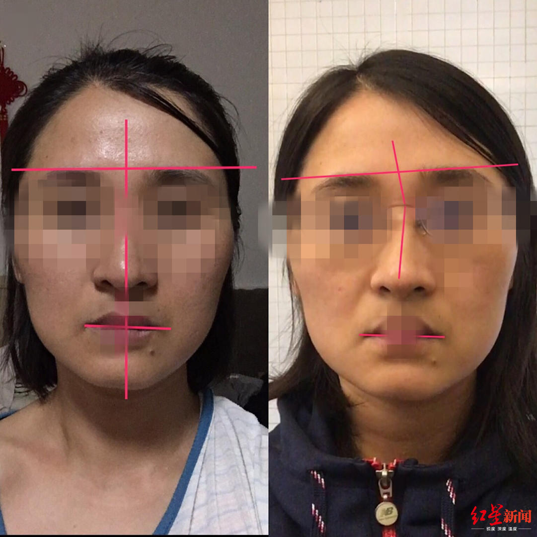 做了5次调理后,女子认为脸仍旧是歪的(左为面部正骨前,右为面部正 