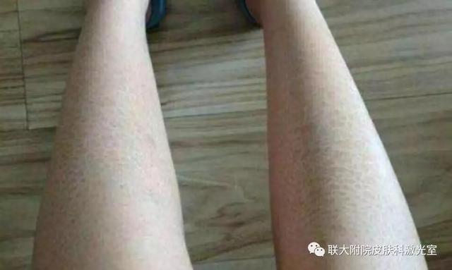 长了蛇皮纹(鱼鳞病)怎么办