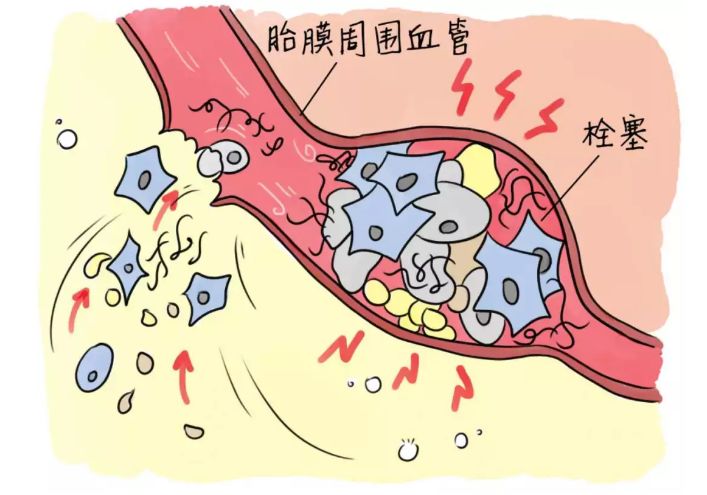 羊水栓塞也太吓人了,还是剖腹产来得安全点?