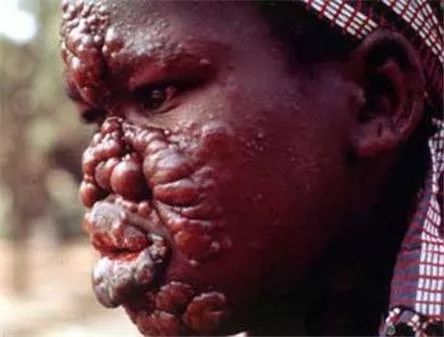 被嫌弃的传染病人的一生