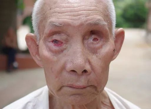 没有任何征兆地,他们的脸,甚至眼睛会逐渐溃烂,而手脚则会萎缩腐烂