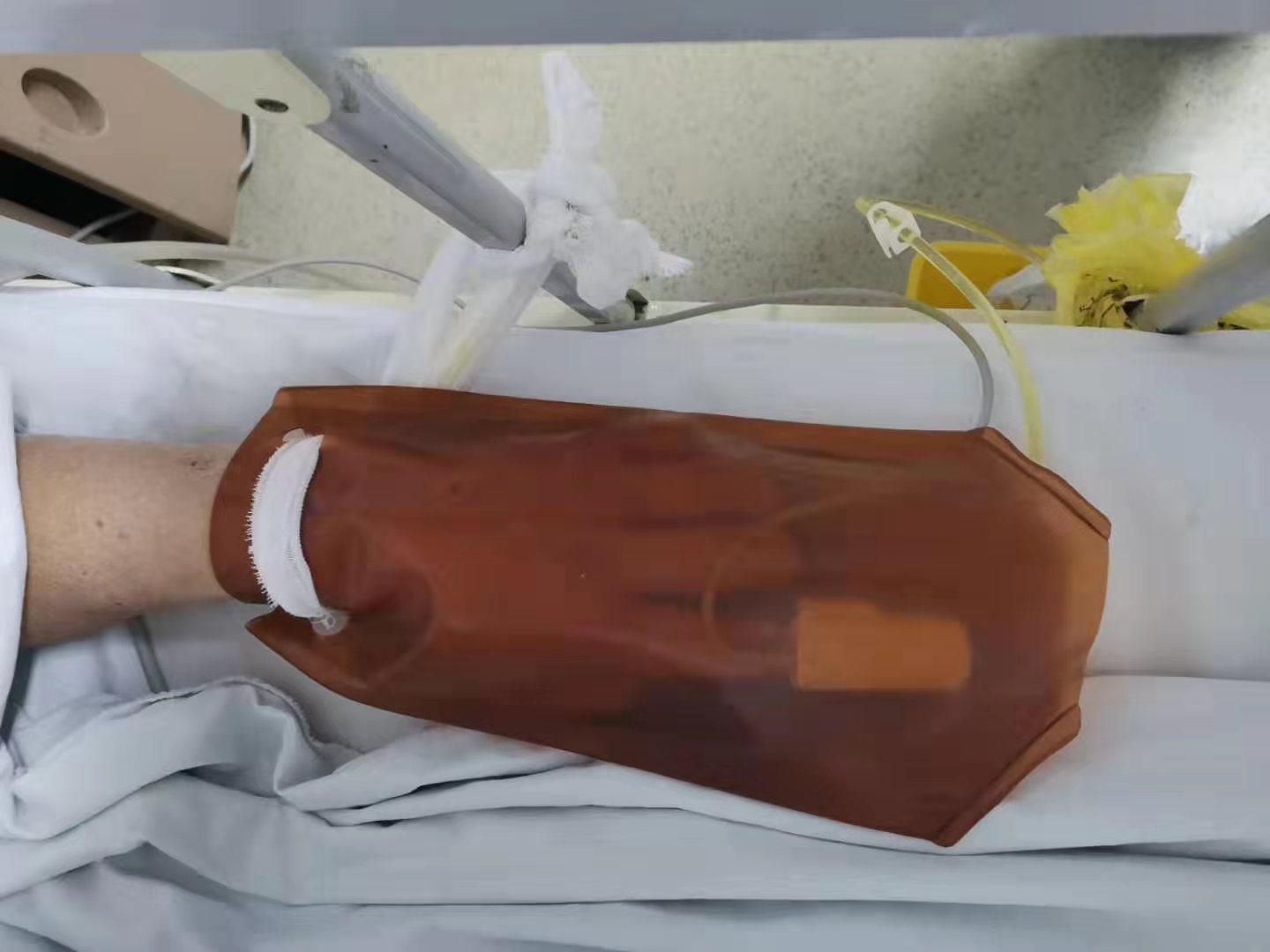 医护日记预防患者意外拔管我自制了简易手套式约束带