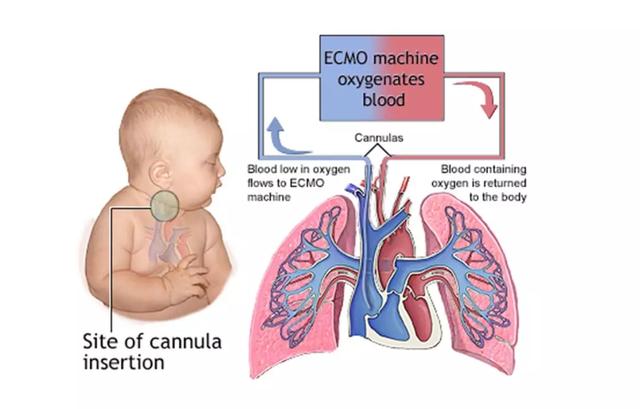 解码——体外膜氧合(ecmo)