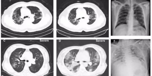· 新冠肺炎患者的CT图像。