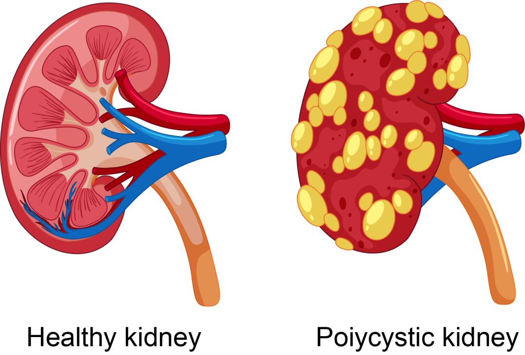 科研绘图:多囊肾脏-3