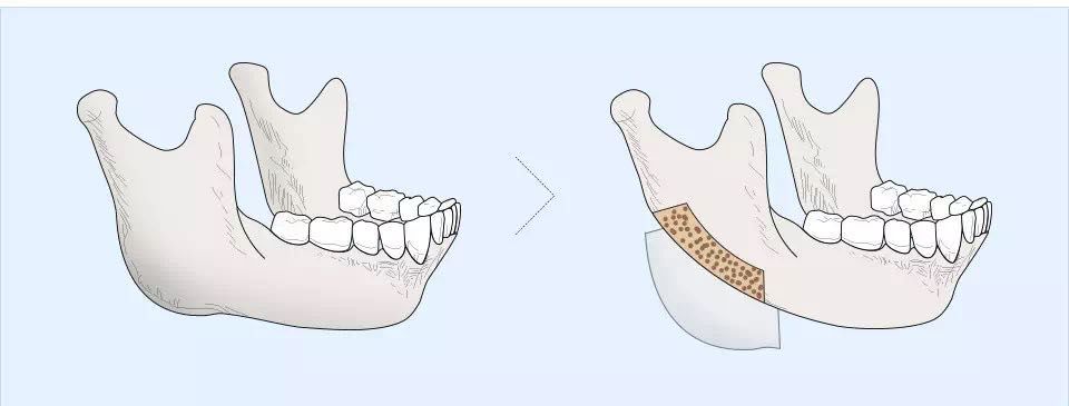 除了天生的额骨性发腮,还有一类姐妹就比较惨了,这部分姐妹下颌骨的