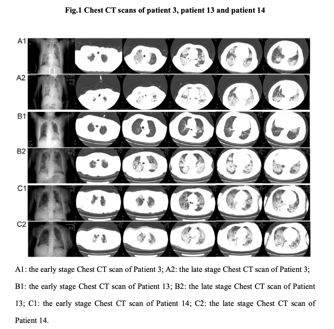 A1与A2，B1与B2，C1与C2分别为三名患者的早期与晚期胸部CT扫描