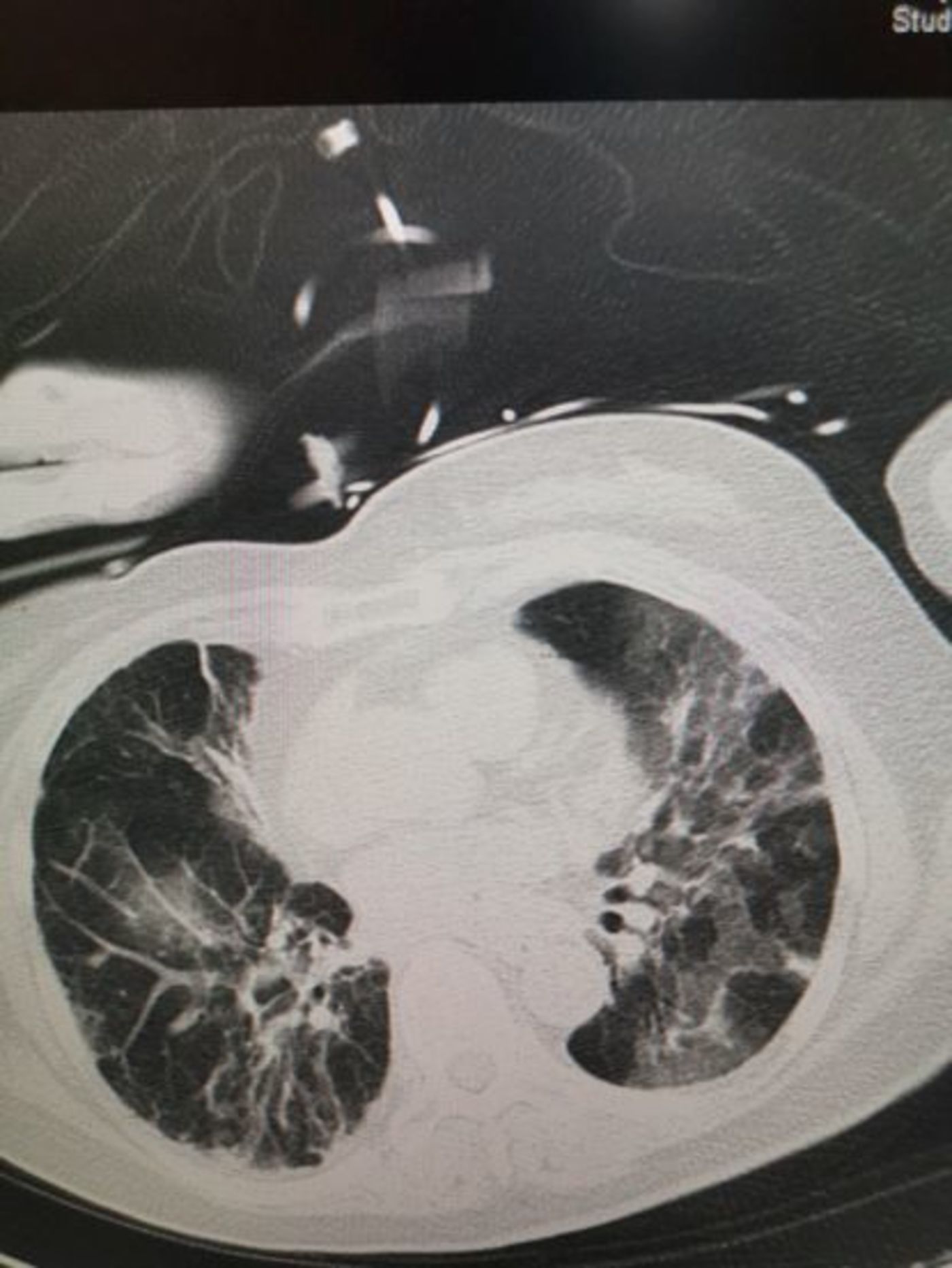 病毒性肺炎的ct表现,渗出增多,透过度降低,呈"白肺"