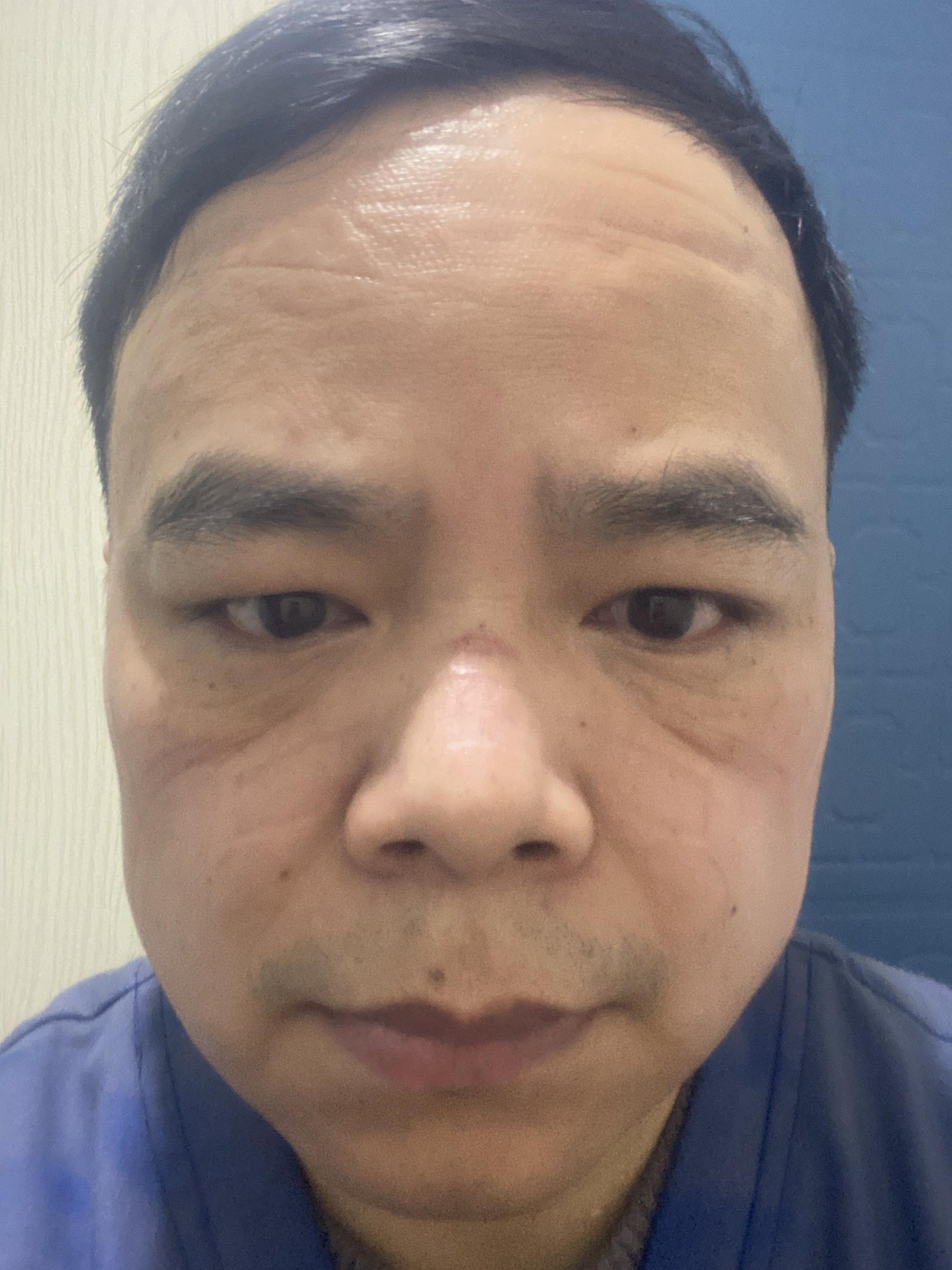 陆华东脸上,口罩勒痕清晰可见. 受访者供图