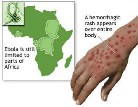 被埃博拉病毒感染后,会出现出血热症状.
