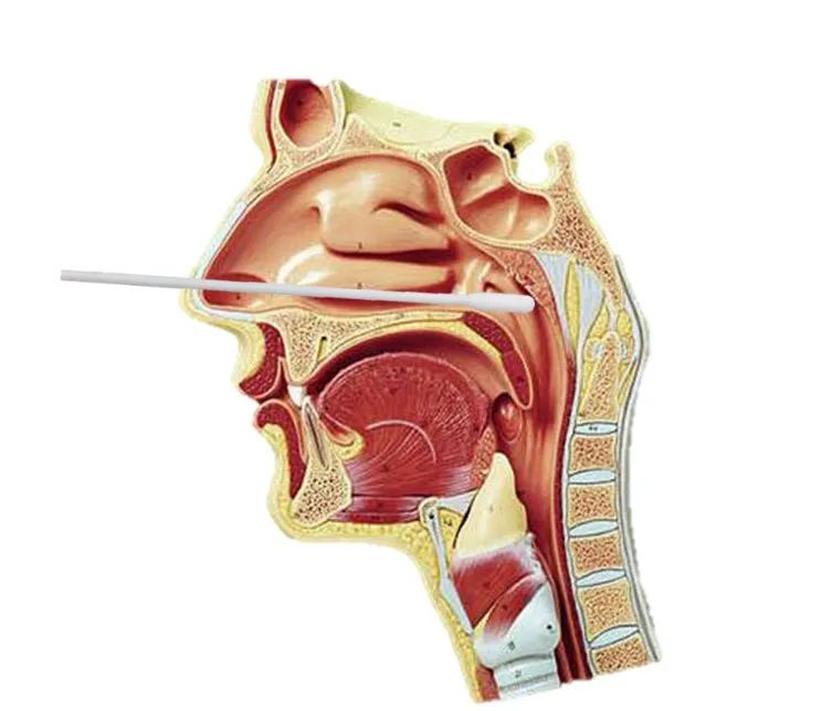 来自武汉前线的科普鼻咽拭子寻新冠为何优于口咽拭子
