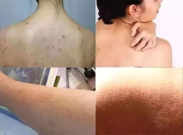 黏附皮肤就是螨虫最爱的环境没搓好澡,小心螨虫爬上身同时,普通搓澡巾