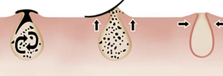 所以排污的关键一步,是要让毛孔全部张开,才能彻头彻尾来一次"深层大