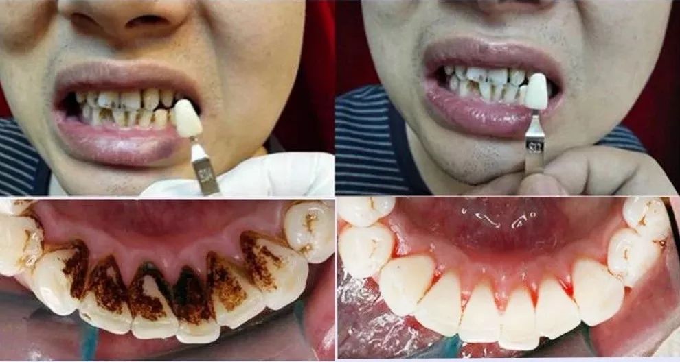 只要坚持喷,就可以看到牙齿表面的黑色污垢得到改善,早上照镜子看着