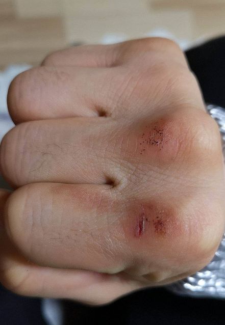 这些训练包括跑步上下班,提升体能;打沙袋练到拳头出血脱皮;腿练不好