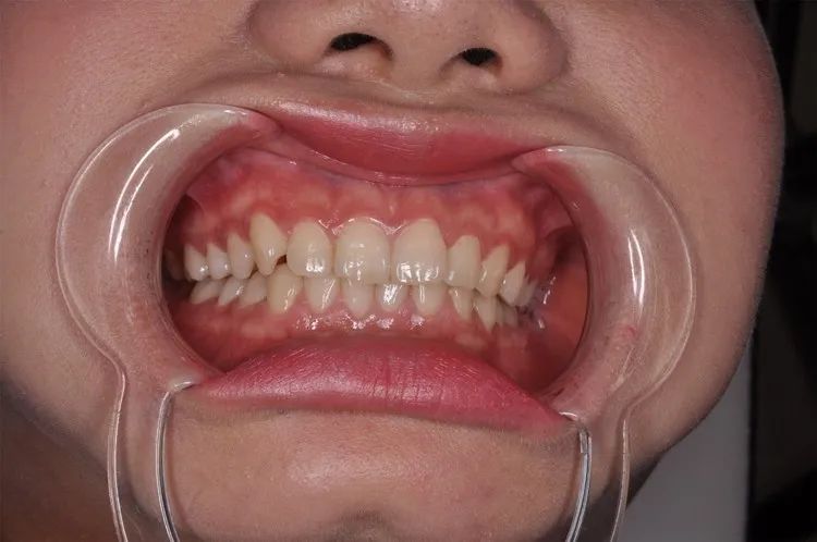 牙缝里黄黄的东西是什么?偶尔还会发臭怎么办?