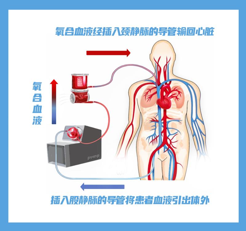 防疫新科普叶克膜ecmo是救命神器吗