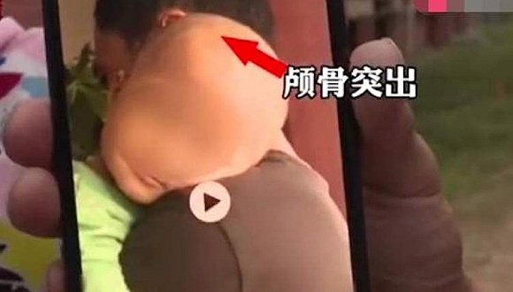 郴州再现"大头娃娃",伪"特医奶粉"生产方回应称"没有夸大宣传"