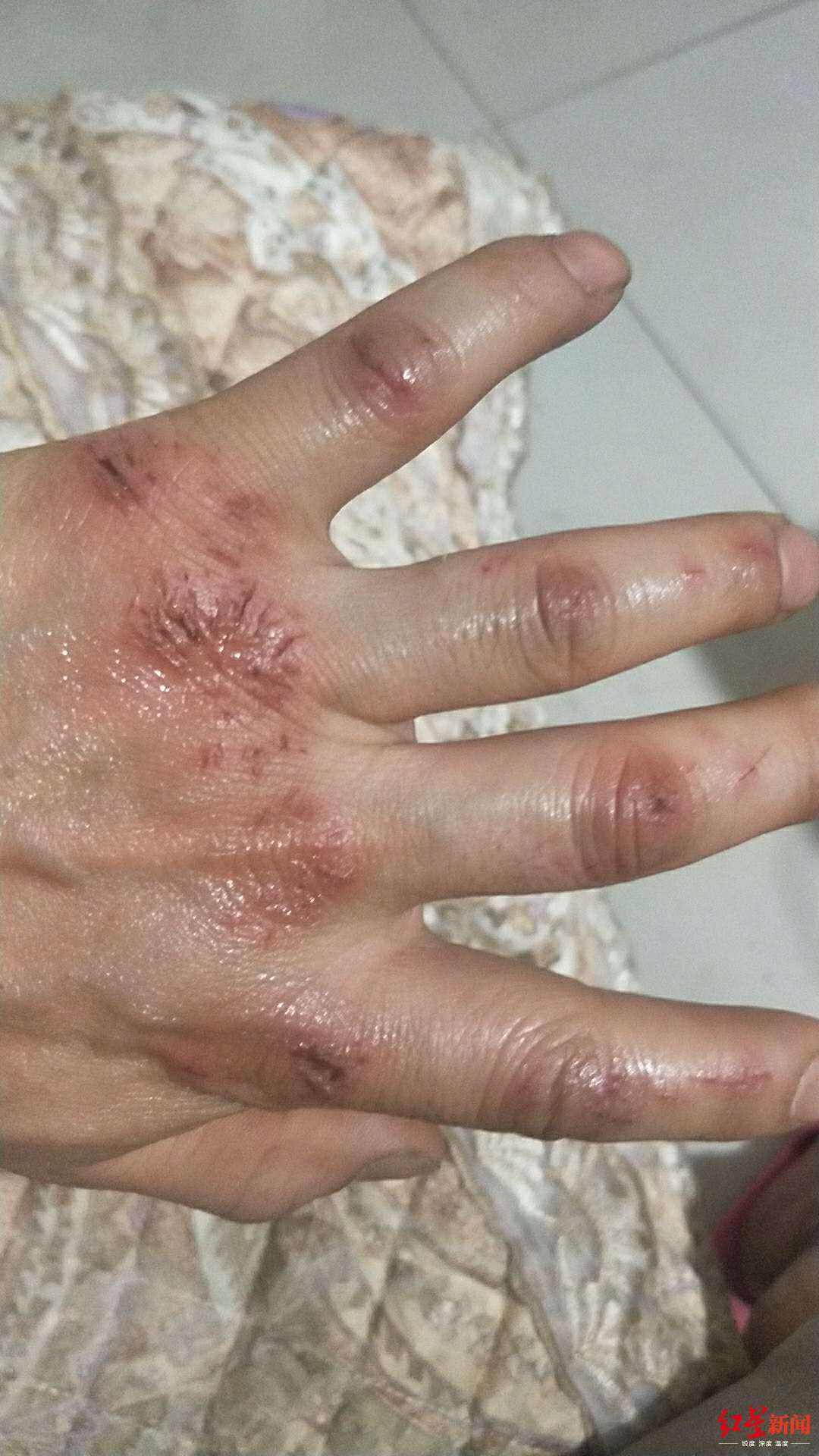 苏冬雪受伤的手