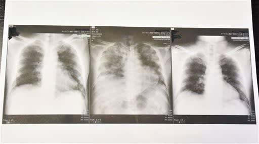 海外网日本重症患者讲述生死劫：瘦到皮包骨 自责传染家人