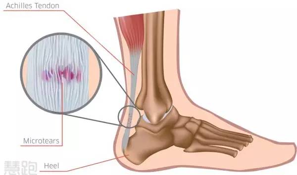 困扰我多年的跟腱病是如何康复的?