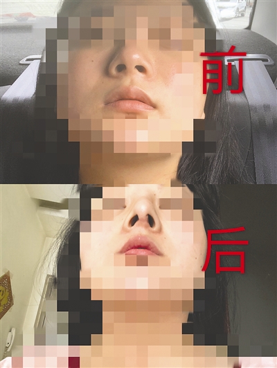 红星新闻|咋回事？在同一美容院整容 多名女子鼻子歪了