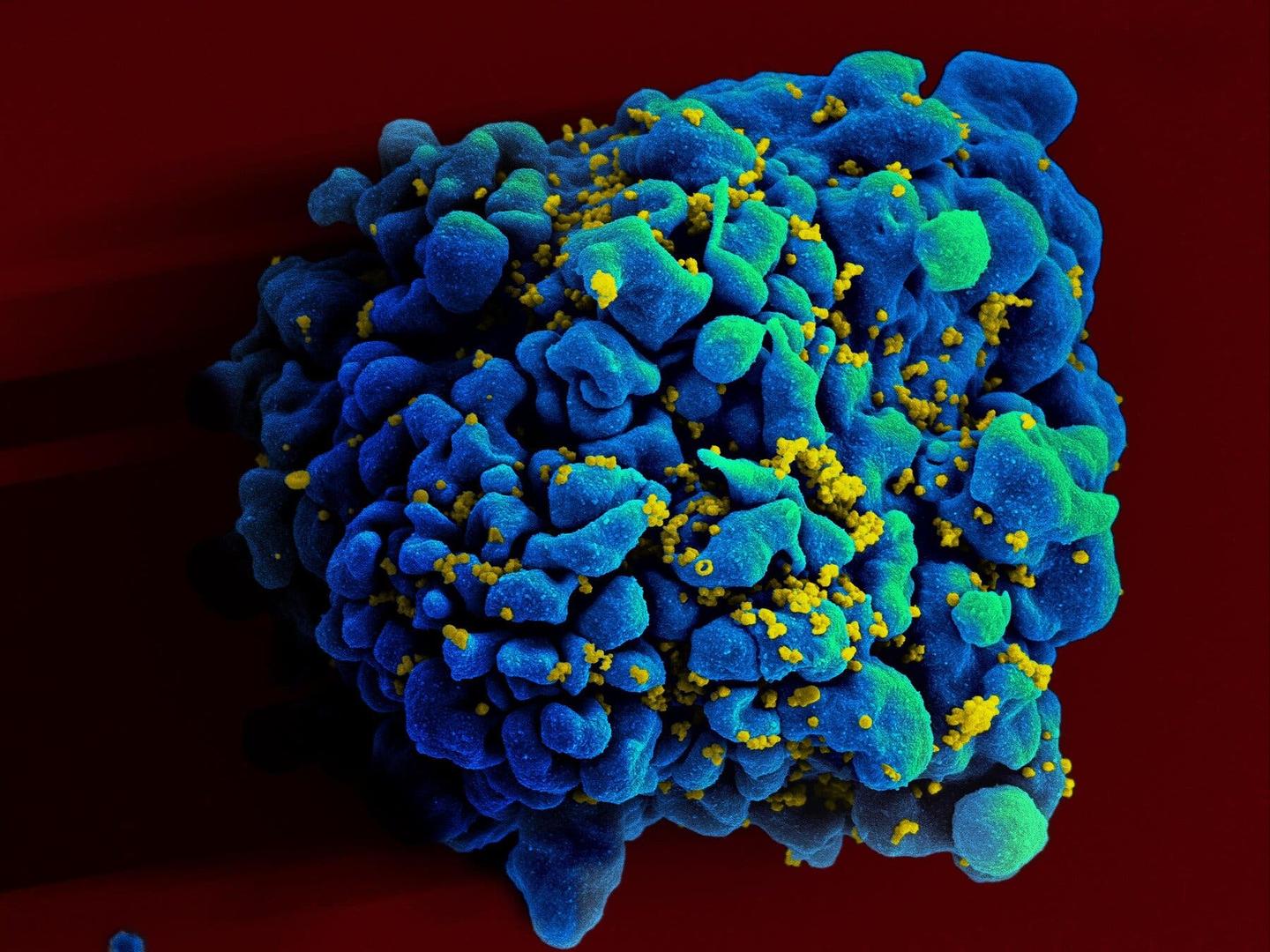 艾滋病毒感染的人体T细胞着色扫描 图据《纽约时报》