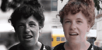 ▲紫外灯下脸部潜伏的真实晒斑