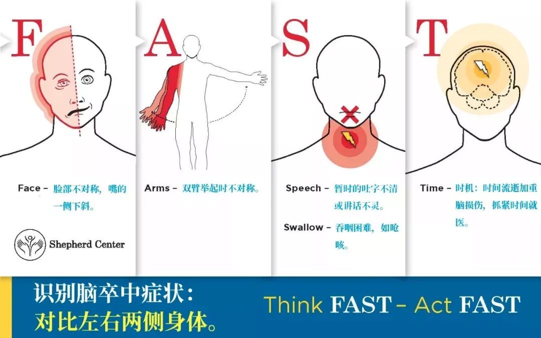 图为"fast"法则判断脑卒中.图源:shepherdcenter