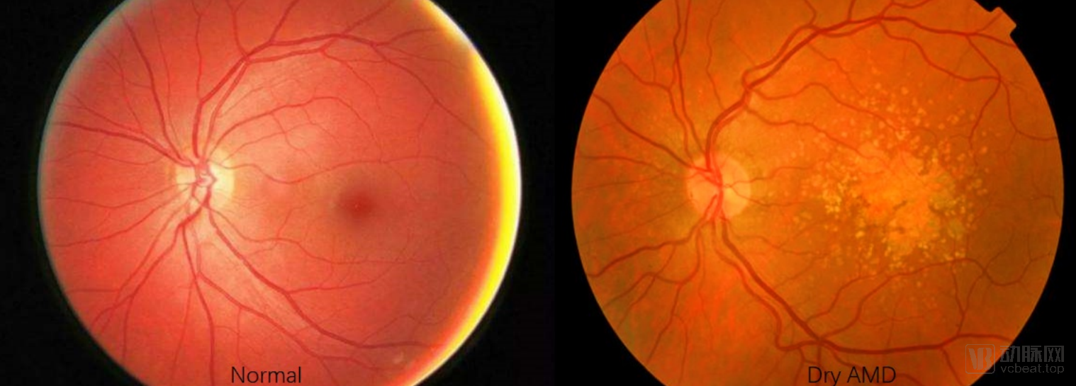 视网膜的中央有一直径约5mm的区域称为黄斑,其中央有一小凹为黄斑中心