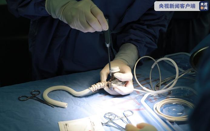 上海医疗团队完成华东地区首例全国产心室辅助装置植入