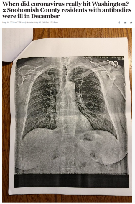 △《西雅图时报》报道截图（题图中的X光片显示其中一位斯诺霍米什县居民的肺部“过度充气”并出现“线性混浊”。医生认为，这可能是叠加上呼吸道肺部感染的表现。）