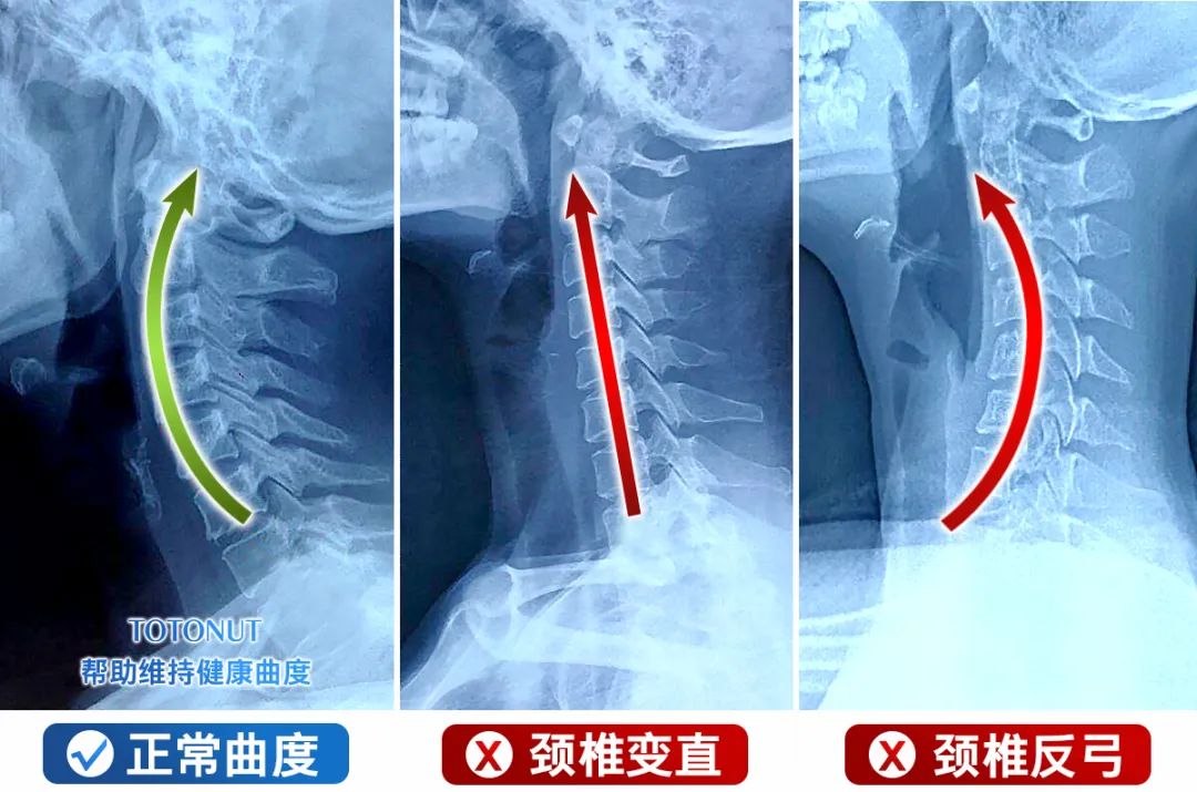 颈椎曲度变直对比图片