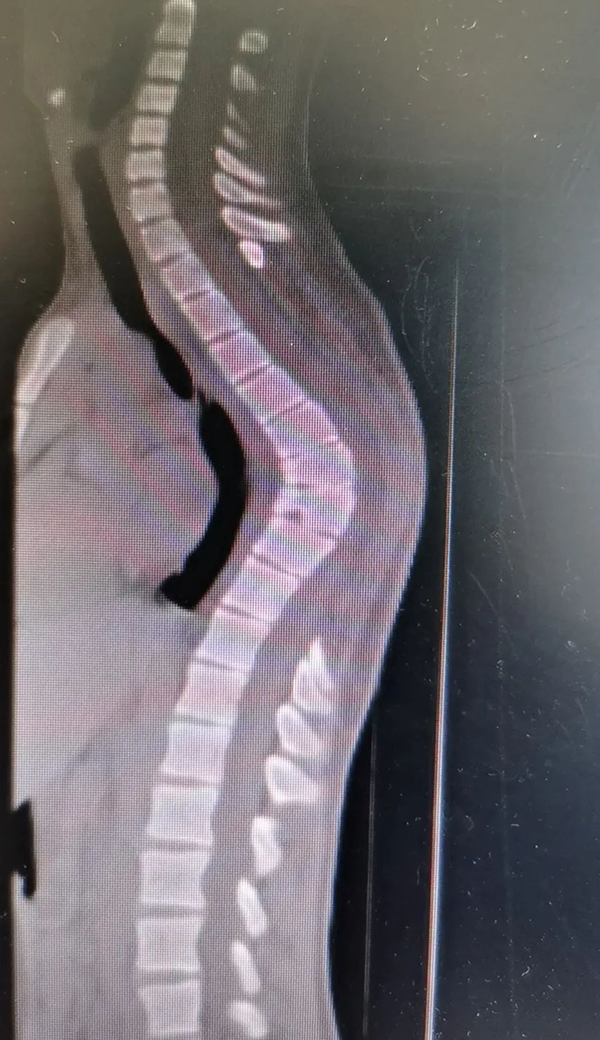 脊柱后凸70普陀医生帮男孩打开折叠人生