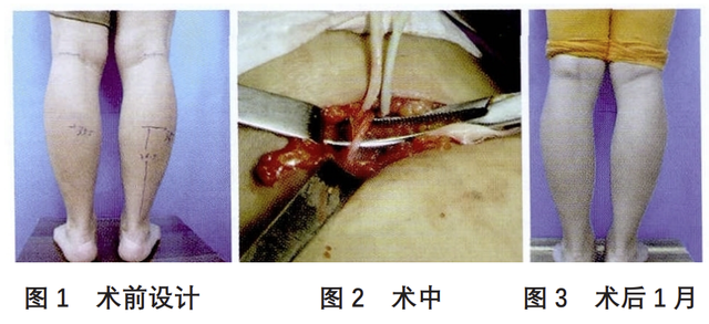 切断小腿神经以瘦腿这一手术被国家卫健委叫停